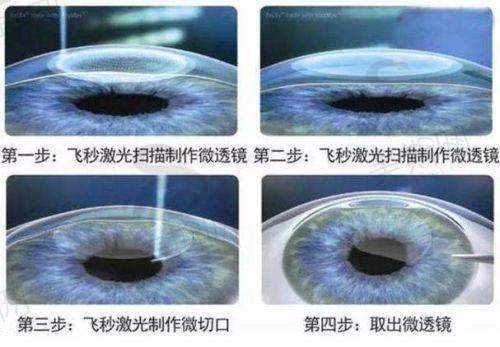 【实例2】白内障合并老花患者：一次手术解决