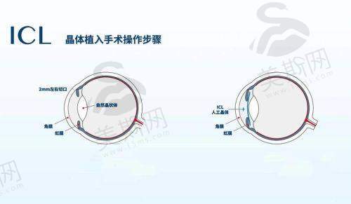 广州市第一人民医院眼科价格表