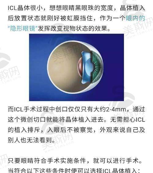 四、重庆南坪爱尔眼科ICL晶体植入真实口碑实例分享