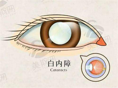 散光矫正型晶体的技术原理：精细定位是关键