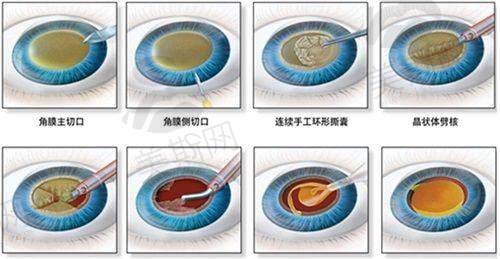保定第一中心医院眼科网上挂号攻略