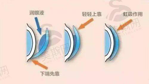 飞秒手术与晶体植入手术对比
