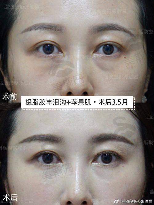 北京自体脂肪填充骨干医生