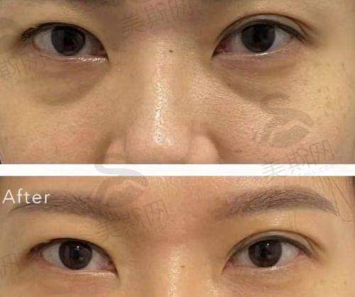 北京自体脂肪填充更牛的医生