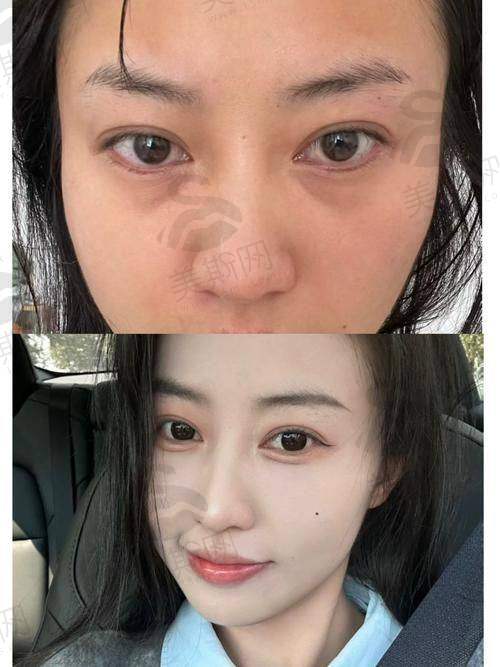 北京自体脂肪丰胸医生排名