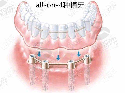 杭州雅莱口腔连锁医院特色技术