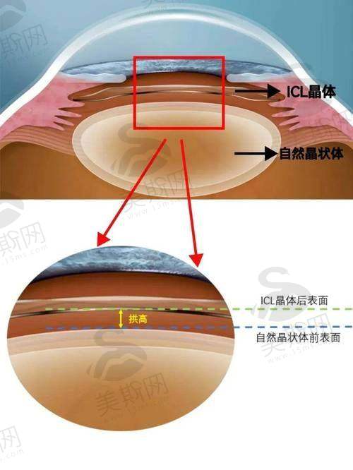 蔡司晶体2025价格表：与竞品价格对比及选购建议
