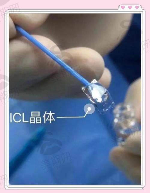 蔡司vs强生vs国产人工晶体价格对比：2025年差价更高118%，怎么选不花冤枉钱？
