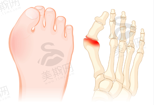 腹壁整形术价格信息