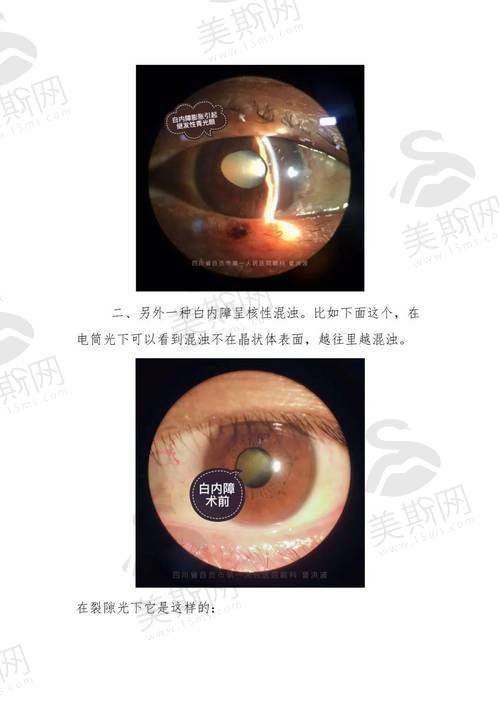 实例3:高度近视性黄斑病变的“救赎”——刘卫民(化名)的光明之路