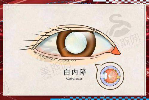 刘卫平:糖尿病视网膜病变的“终结者”
