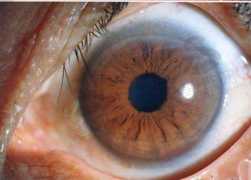【实例二】晶状体脱位合并外伤,创新手术重建视功能