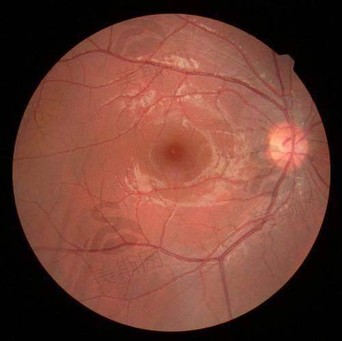 实例一：黄斑裂孔患者修复记