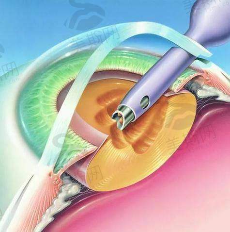 一、显微操作精度达微米级,手术创伤控制行业领跑