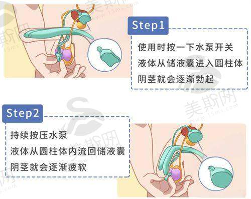 成都杨迪医生双眼皮实例展示