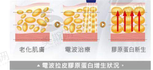亲身体验李建钢无痕筋膜提升手术过程