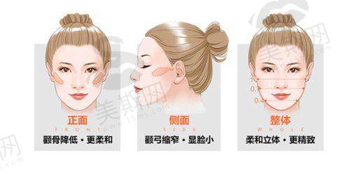 袁强博士拉皮价格