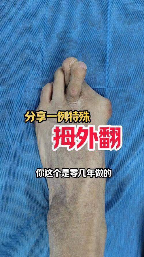 6、成都大脚骨微创手术费用排名第六：成都美莱整形医院
