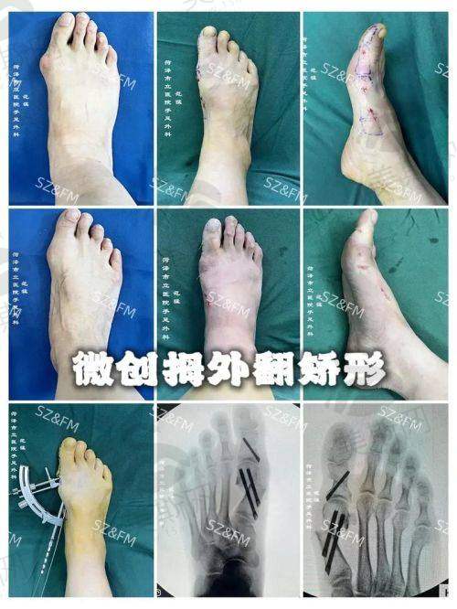 7、成都大脚骨微创手术费用排名第七：成都娇点整形医院