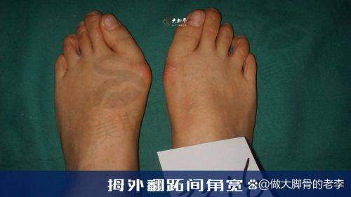 5、成都大脚骨微创手术费用排名第五：成都军大整形医院
