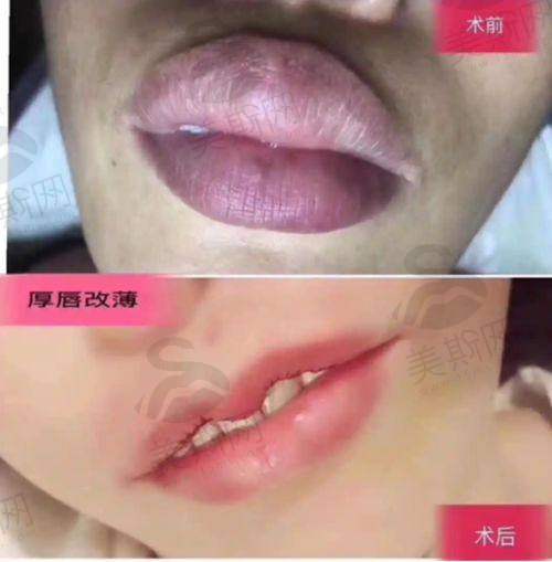 第一位分享者的广州健丽去眼袋价格