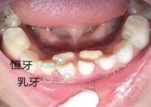 第一位分享者的广州健丽去眼袋优势