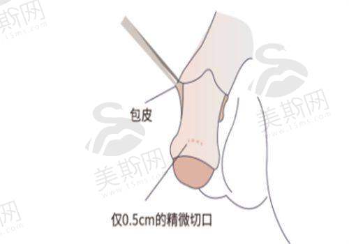 吕方中医生修复双眼皮技术情况