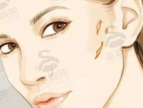 实例一：三次修复鼻终获自然美鼻
