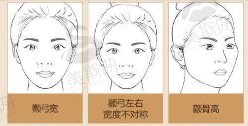 实例2:半肋骨鼻修复——拯救“通天鼻”失败修复