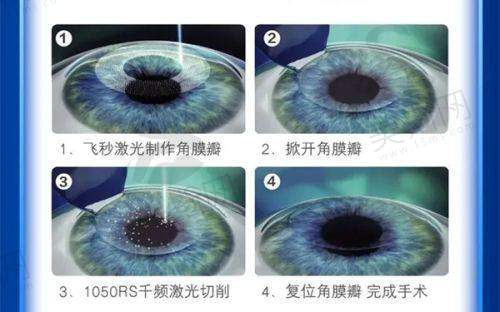 爱尔眼科角膜塑形镜价格总体情况