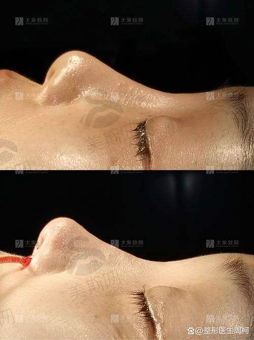 肋软骨/鼻中隔综合鼻整形