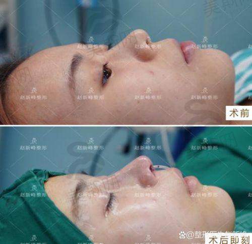 3. 鼻部亚单位“24区精细分区”设计,实现整体协调美