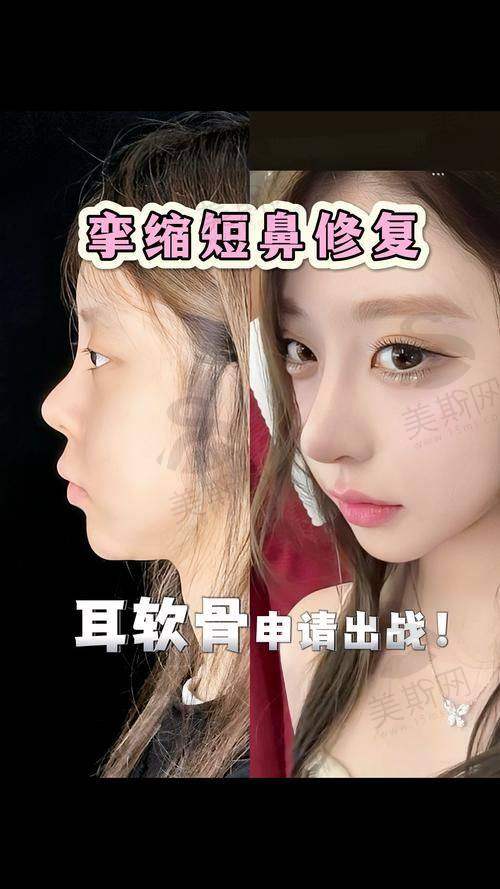 实例2:唇裂鼻畸形修复,从“自卑鼻”到“自信颜”