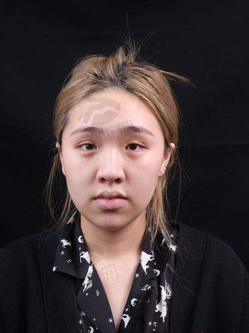 5. 唇裂修复三维矫正:鼻唇同步美学重建
