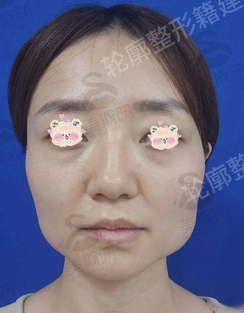 三、罗延平医生技术水平高