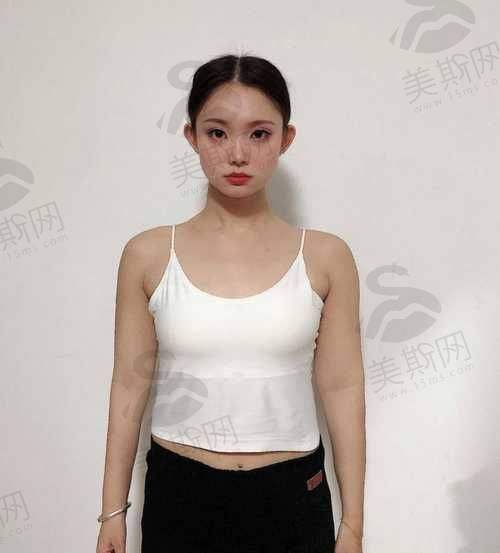 全身吸脂塑形