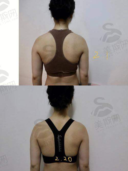 毛发种植