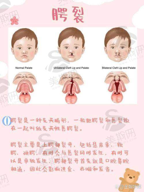 唇裂鼻唇畸形修复