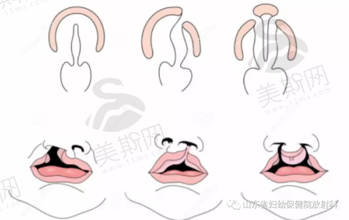 3. 生物力学平衡设计,避免术后复发