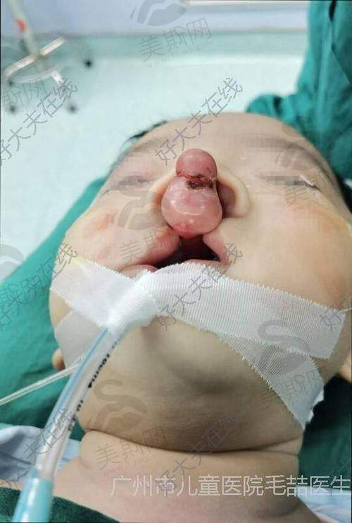 实例1:多次修复后挛缩鼻,术后2年稳定自然