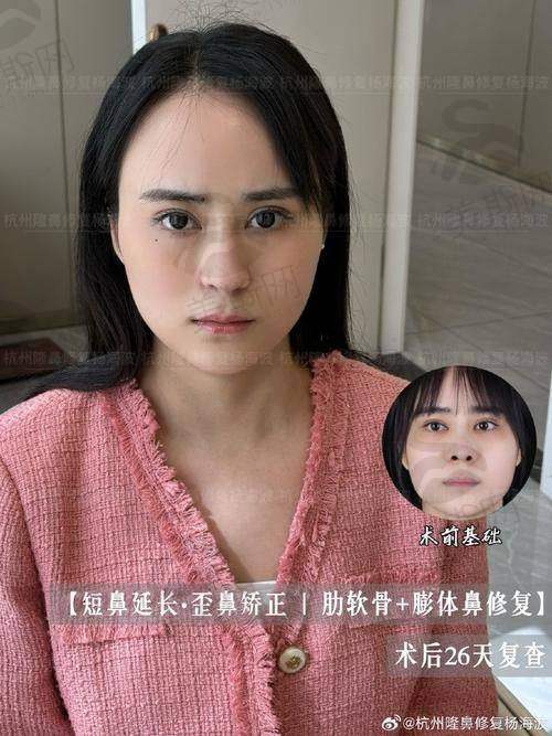 实例3:无痕动感隆胸——下垂乳房矫正+假体隆胸