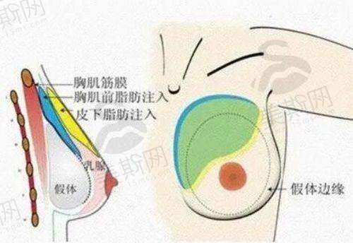 广州韩妃做的风筝小拉皮手术提升下颌缘的效果，维持时长、有无副作用及成功案例大揭秘！