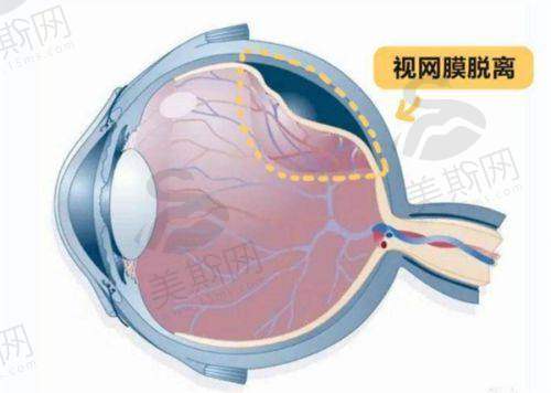 误区3：“术后能熬夜、看手机，完全不用忌口”