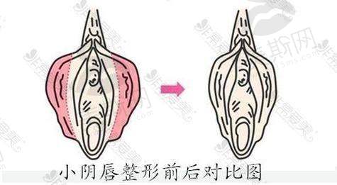 成人割皮包术前术后还要花多少钱？——别忽略这些“隐藏费用”