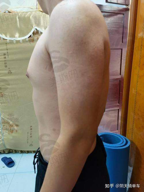 男士埋珠手术费用图片：入珠2圈两年后成效对比