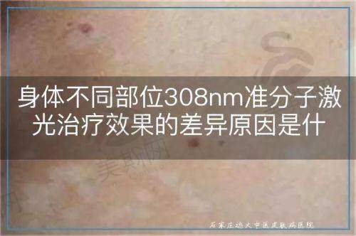 4. 术后干眼能避免吗？