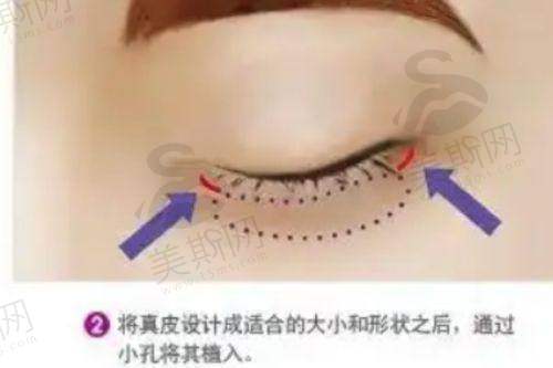 张海明医生双眼皮修复及初眼打造实力分析