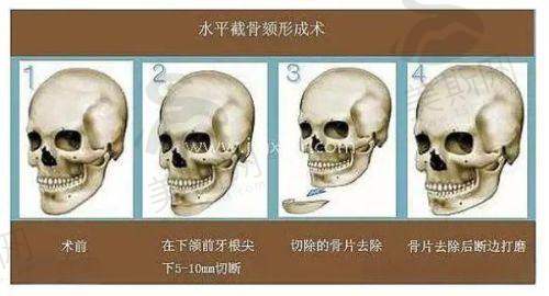 兰州正规脱毛医院排行榜