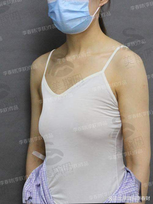 深圳阳光整形美容医院隆胸技术如何