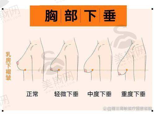 深圳阳光曼托假体隆胸怎么样?揭秘深圳阳光整形医院隆胸效果、技术及正规性!